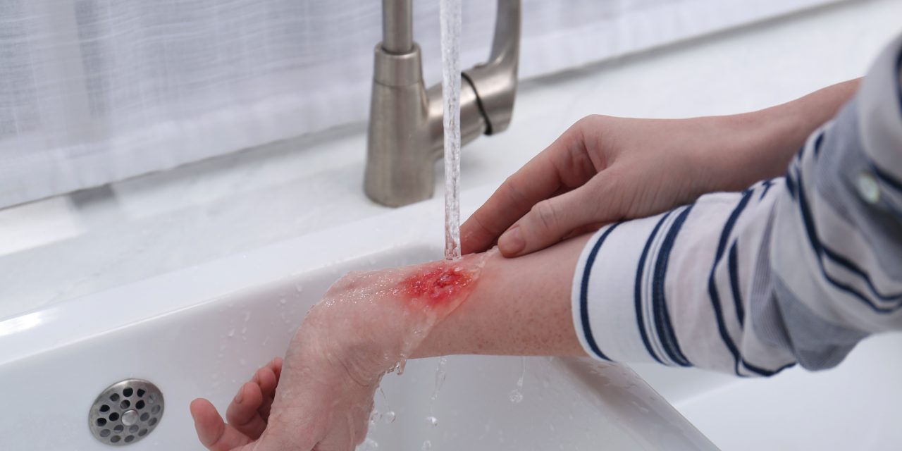 How to treat a burn at home & when to see a doctor