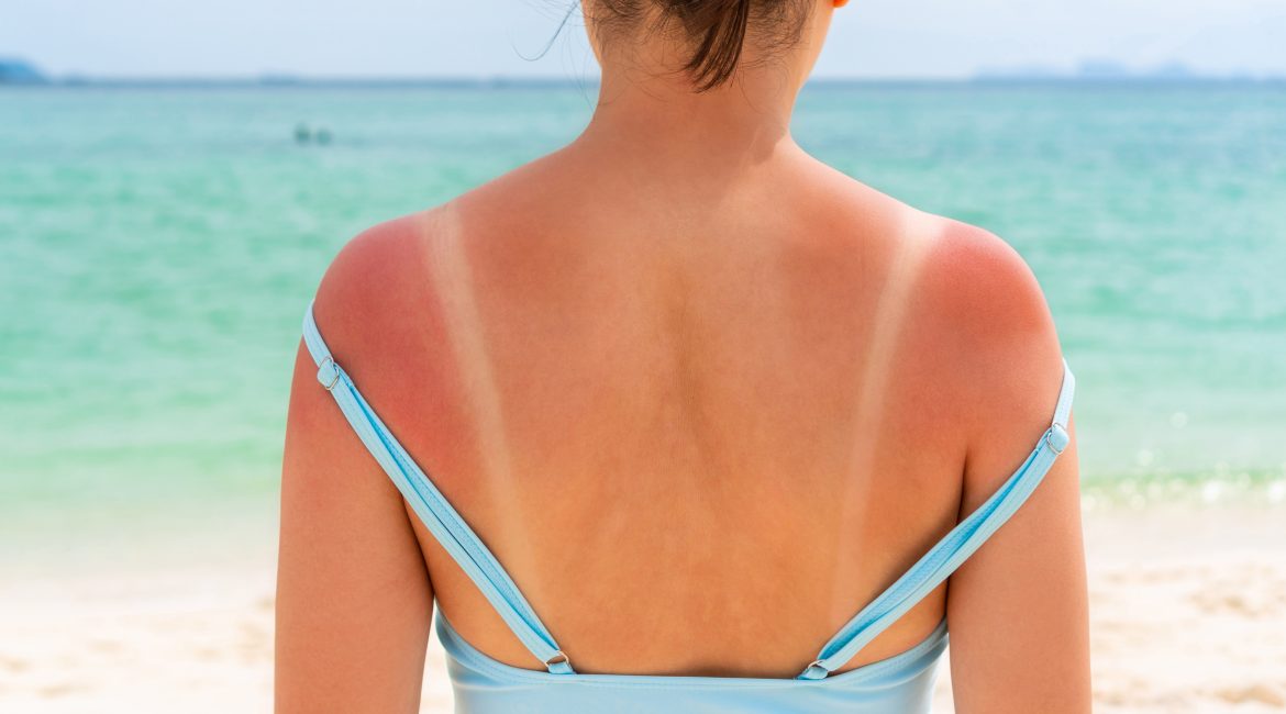 sun damage